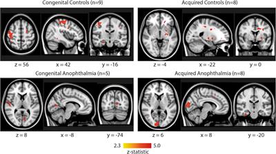 Functional Brain Imaging During Extra-Ocular Light Stimulation in Anophthalmic and Sighted Participants: No Evidence for Extra-Ocular Photosensitive Receptors